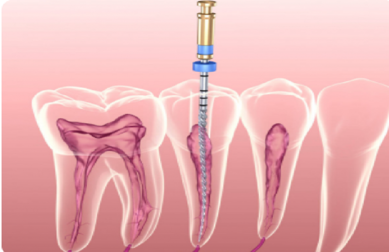 Endodontie Wurzelbehandlung